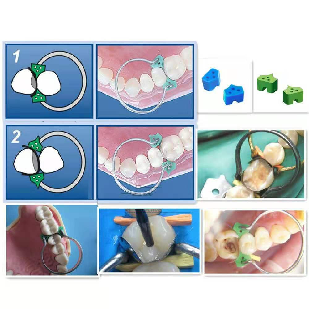 sectional matrix dental filling process