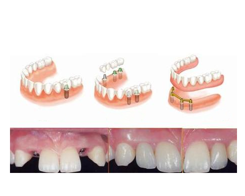 General Description of Dental Implant Indications