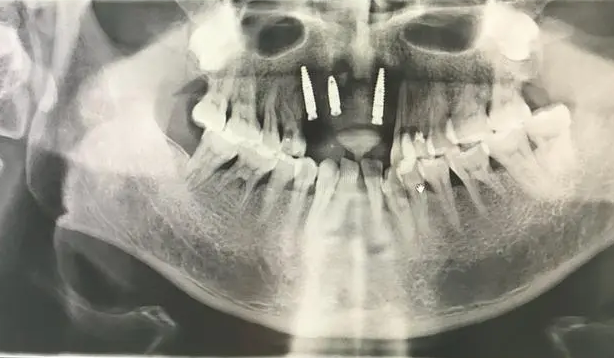 dental implant x-ray