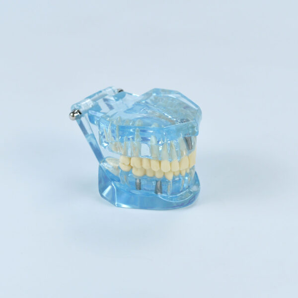 Implant tooth dental model and crown bridge demonstrator
