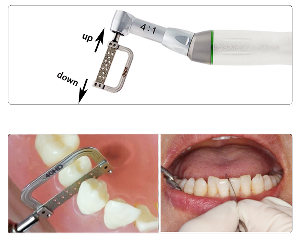 interproximal stripping handpiece in orthodontic treatment