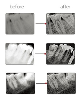 befor and after using x-ray sensor comparasion