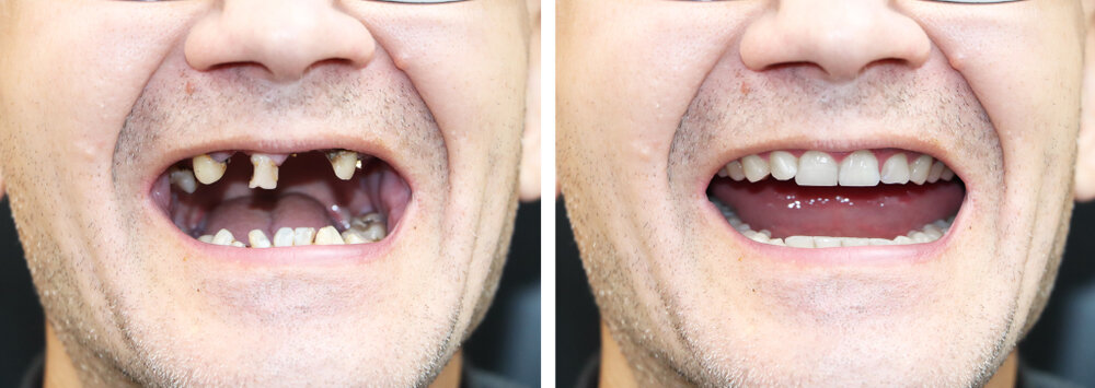 before and after denture comparison effect