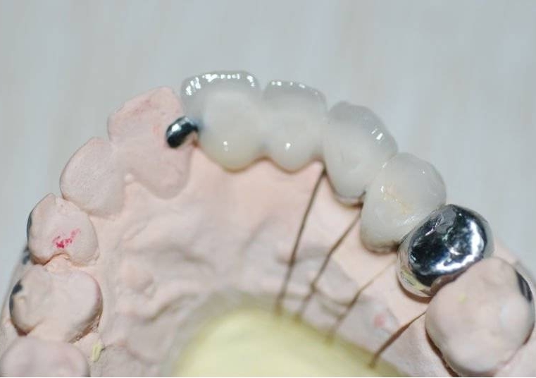 CAD CAM Dental titanium crown
