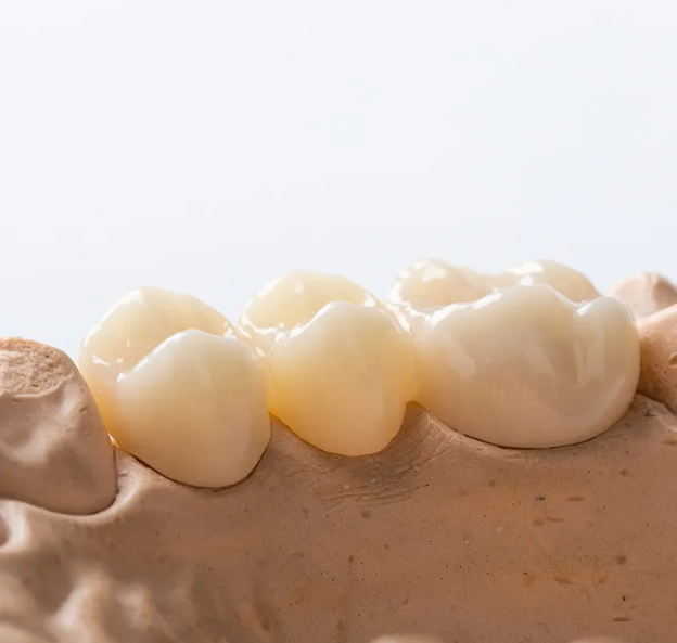 multilayer zirconium crowns made with cad/cam technology