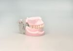 Implant Anchorage Nail Mode with articulator
