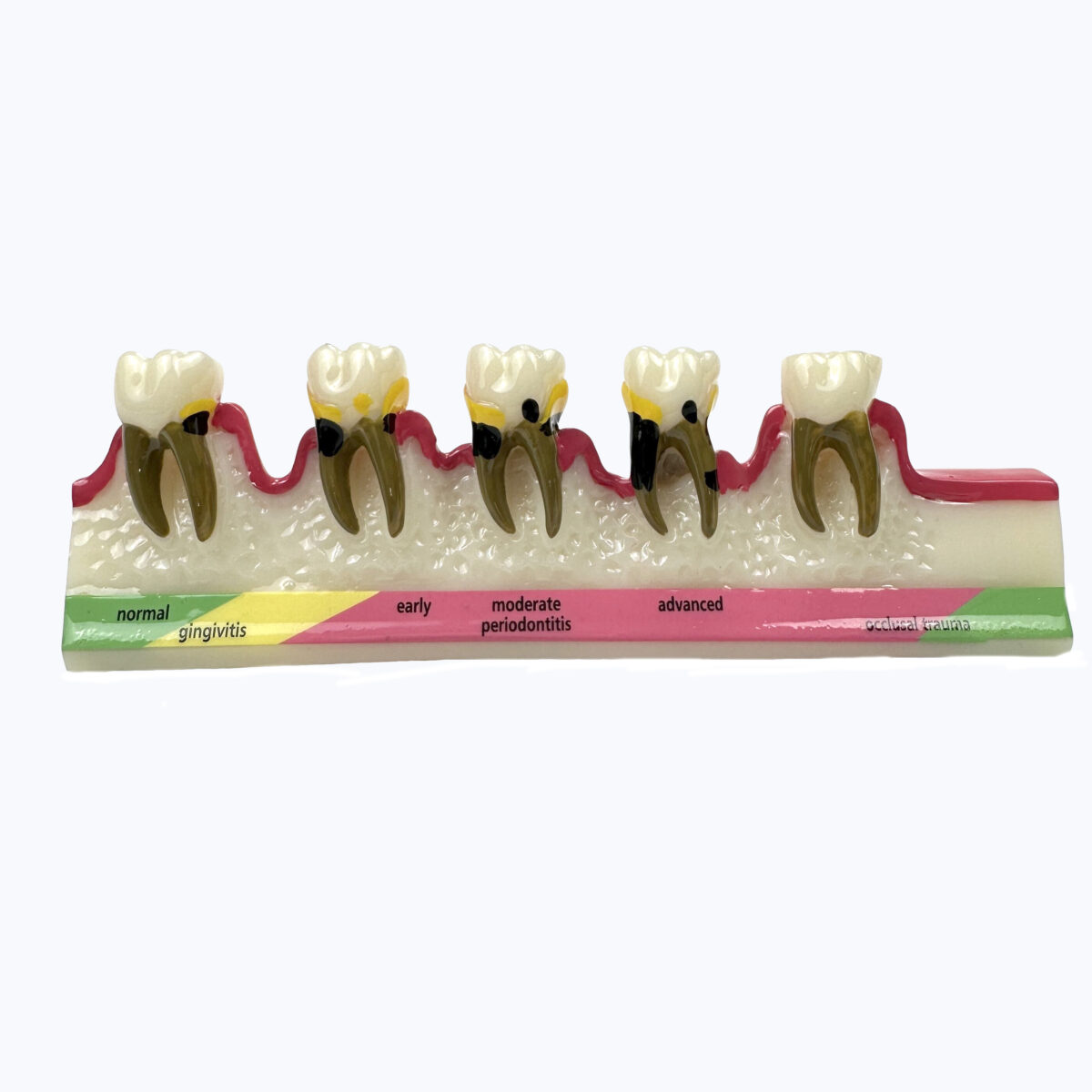 Periodontal Disease Typodont Teeth Model