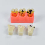 Teaching Model Dental Caries Development Model