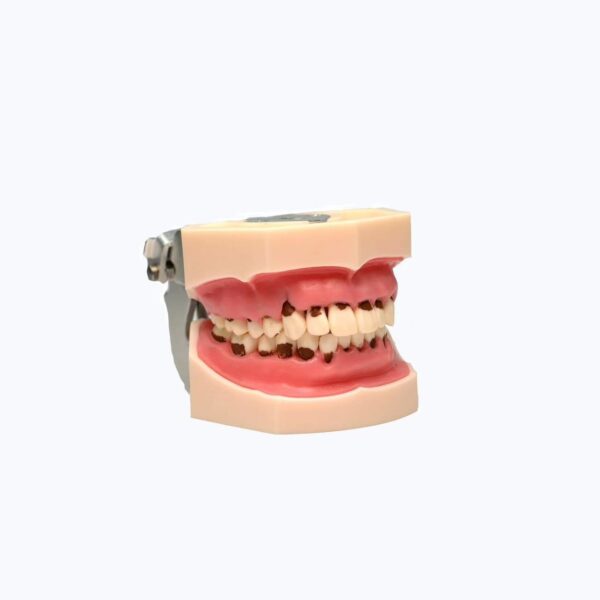 dental calculus model