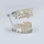 implant model with missing tooth