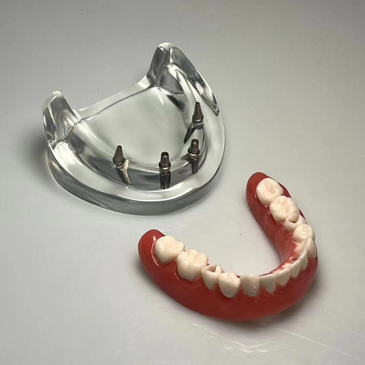 mandilbular implant prosthesis model