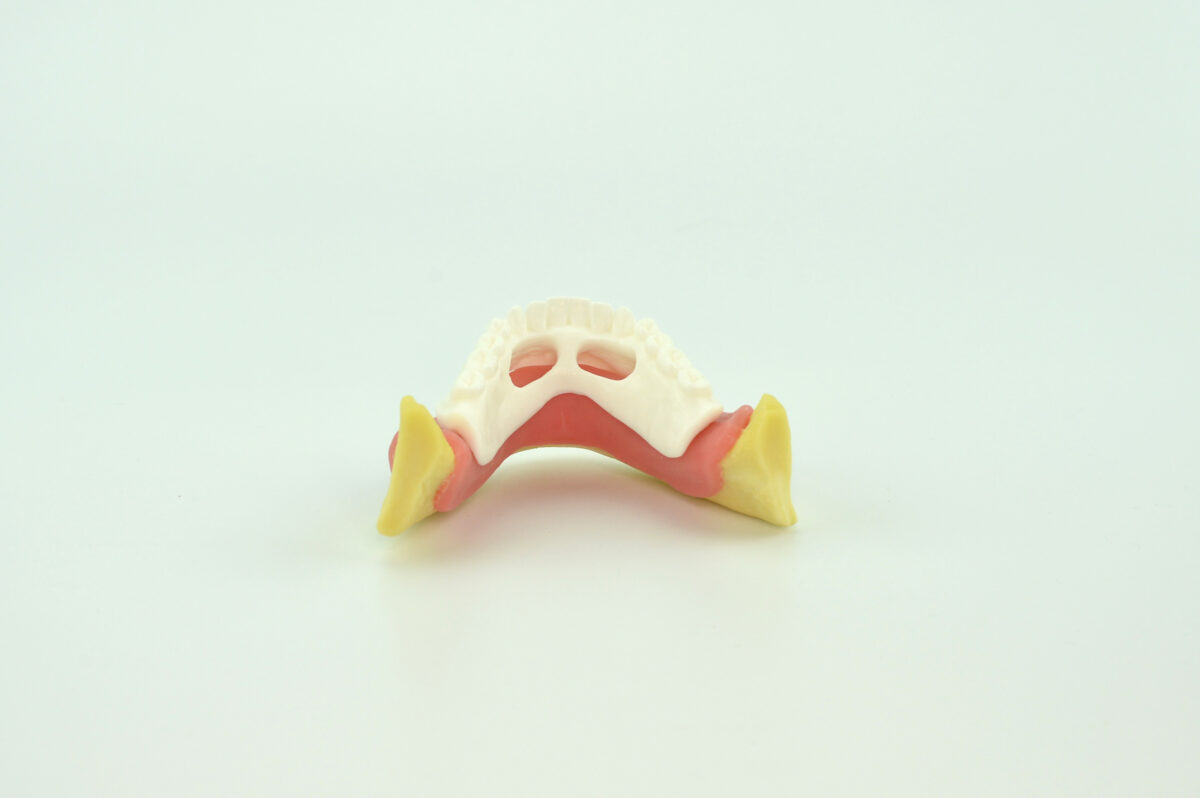 partial gingival mandible