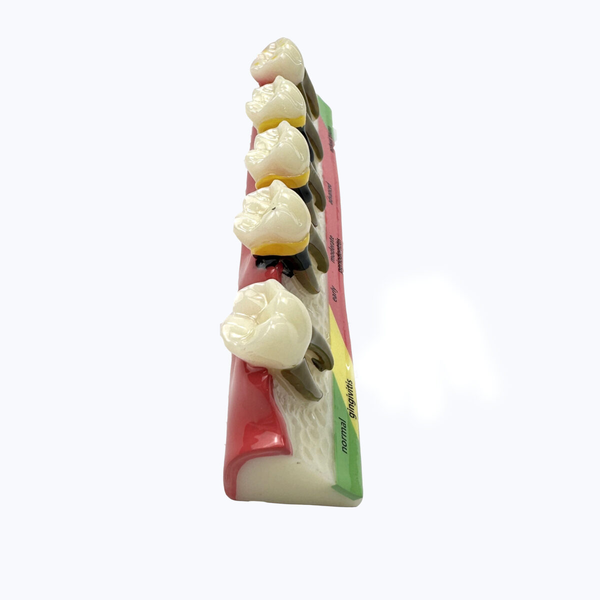 periodontal typodont dental communication model